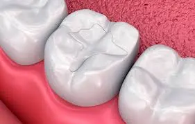 Endodoncia en Opañel