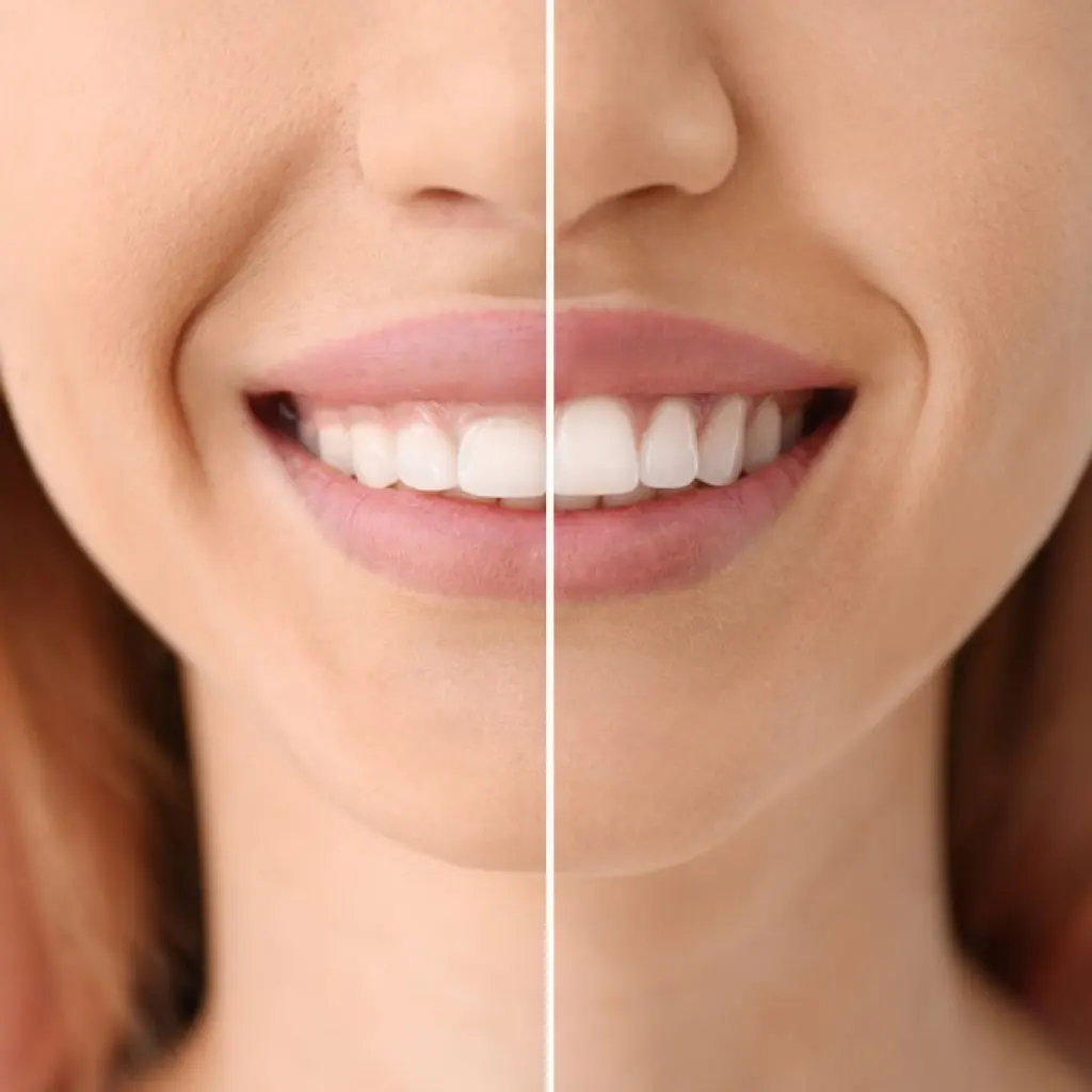Estética dental en Opañel